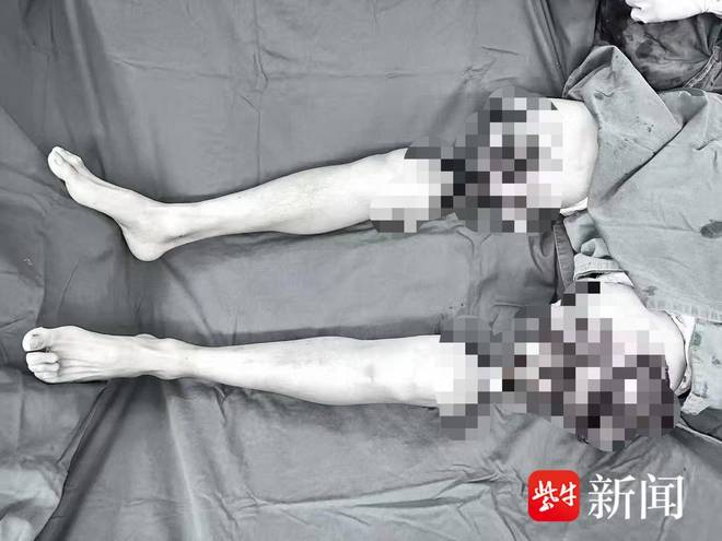 蓝狮平台注册：双腿被机器绞断近20个月后，他已经能借助助行器行走了！医生：远期有望脱离拐杖独立行走